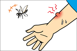 蚊に刺された時の対処法